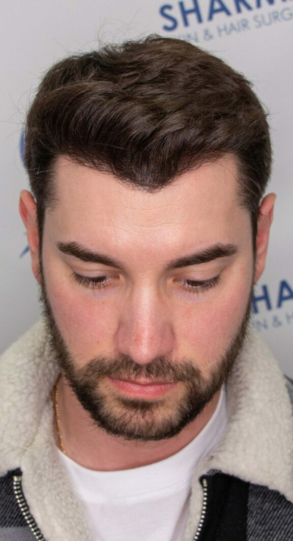 After Hair Transplant - Case 5