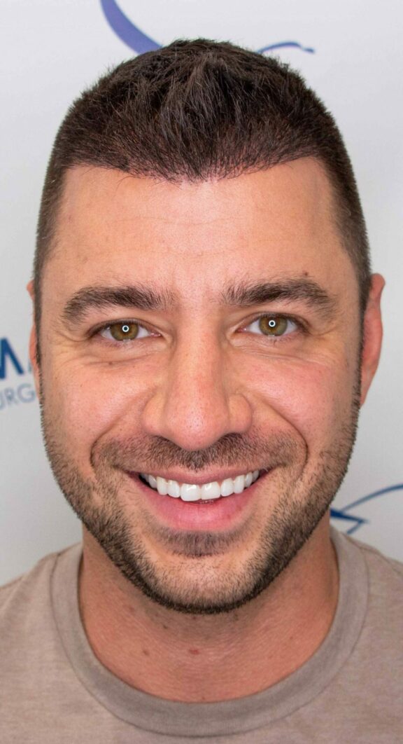 After Hair Transplant - Case 6
