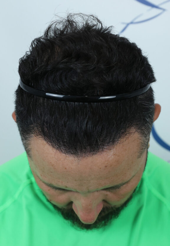 After Hair Transplant - Case 8