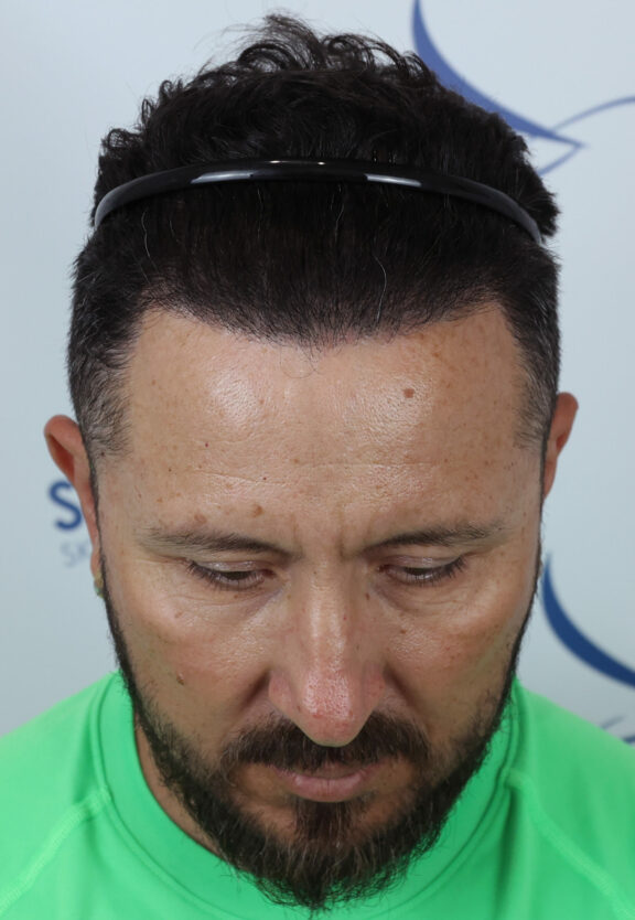 After Hair Transplant - Case 4
