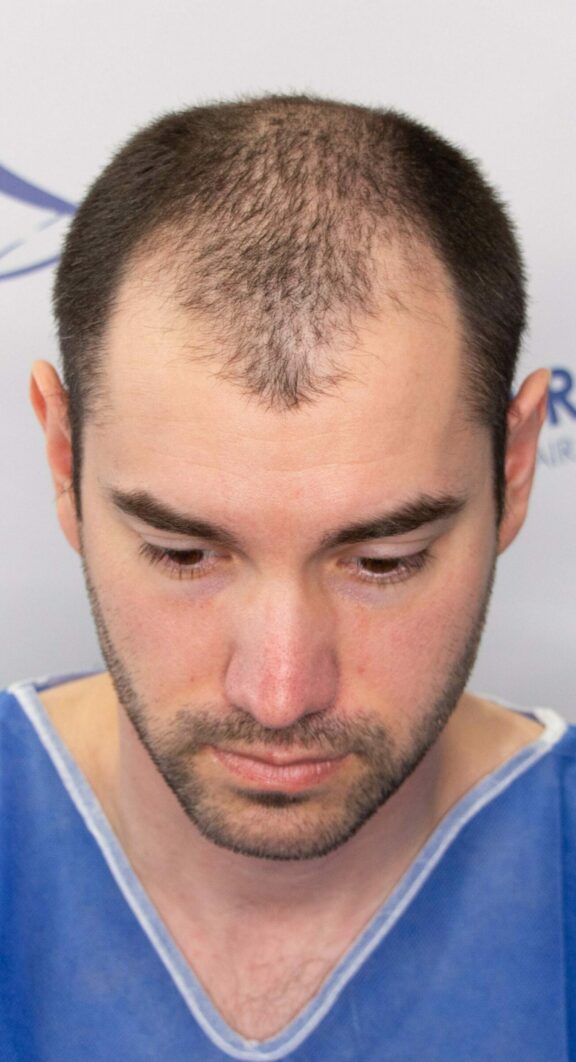 Before Hair Transplant - Case 5