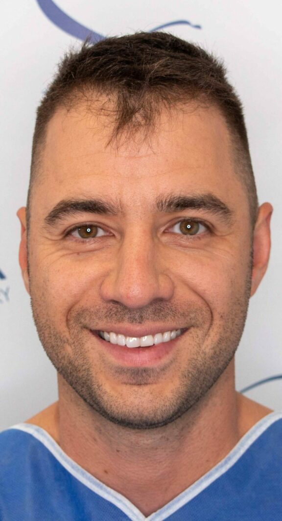 Before Hair Transplant - Case 6