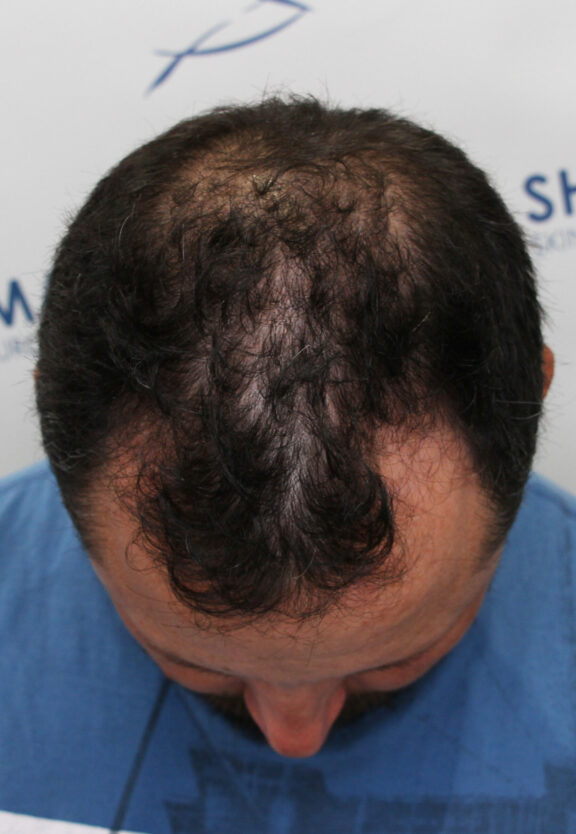 Before Hair Transplant - Case 8