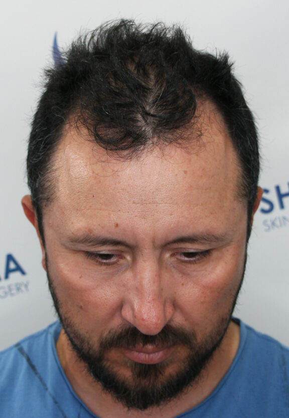Before Hair Transplant - Case 4