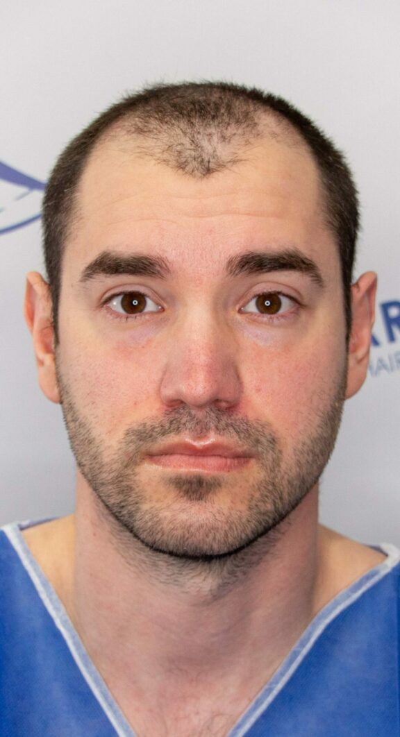 Before Hair Transplant